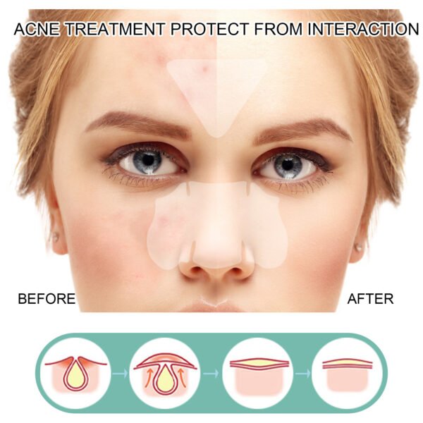 EELHOE Pimple patches. Gentle and non-irritating, they clean and comfort facial pores and skin. Care patches - Image 3
