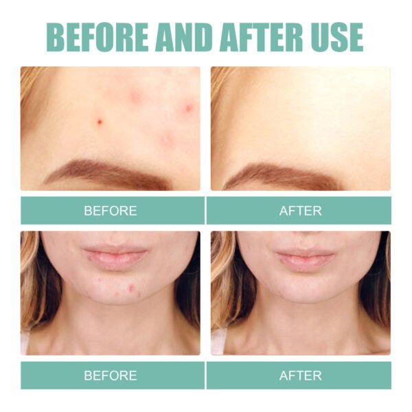 EELHOE Pimple patches. Gentle and non-irritating, they clean and comfort facial pores and skin. Care patches - Image 5