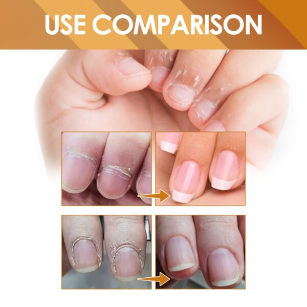 EELHOE Instant Cuticle Care Gel, Repairing Nail Fungus, Soft Nails, Rotten Nails and Dead Skin, Moisturizing Care Liquid - Image 10