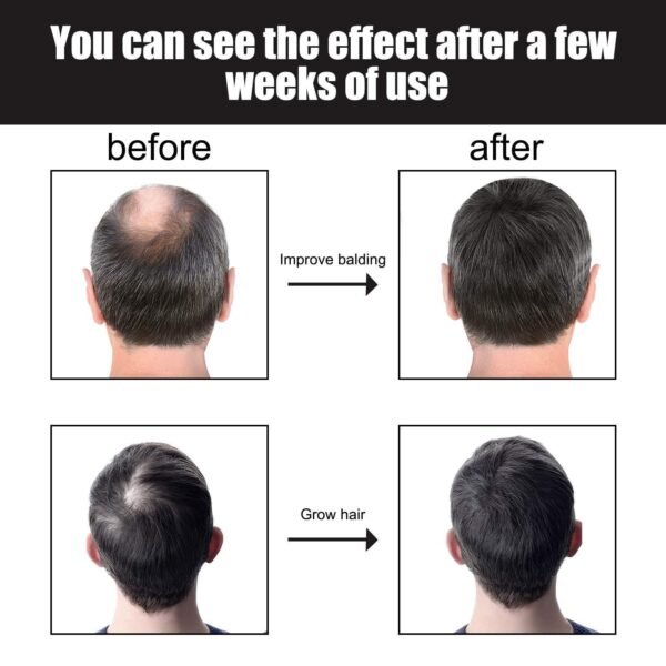 East moon Men's hair thickening essence. It strengthens, nourishes, moisturizes, prevents hair loss, thickens hair, and is a hair care lotion - Image 4